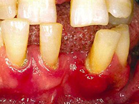 Mất răng nếu không được phục hồi (làm răng giả) sẽ đưa đến hậu quả gì?