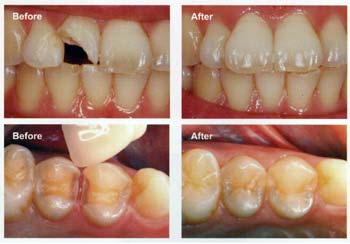 Trám thẩm mỹ