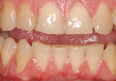 Những nguyên nhân gây hại men răng
